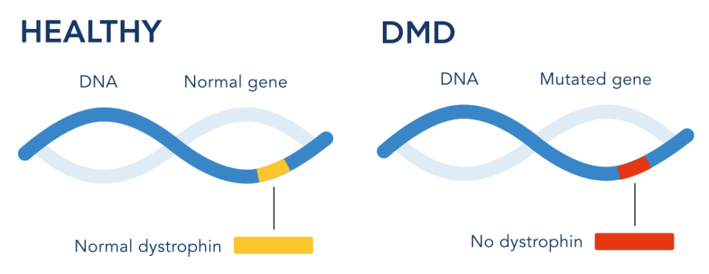 Healthy DNA strand and Altered DNA strand in DMD