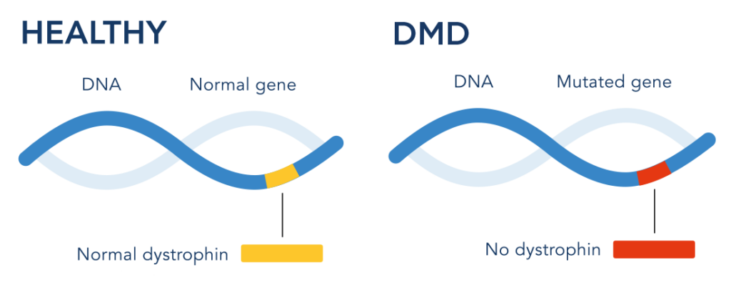 Healthy DNA strand and Altered DNA strand in DMD
